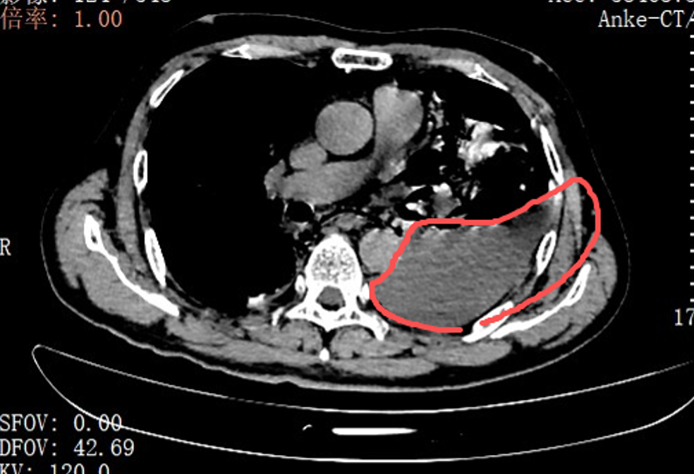 #男子吃2个叉烧包后胸腔漏出剩菜渣#【吃了2个叉烧包，男子凌晨紧急送医！胸腔里全