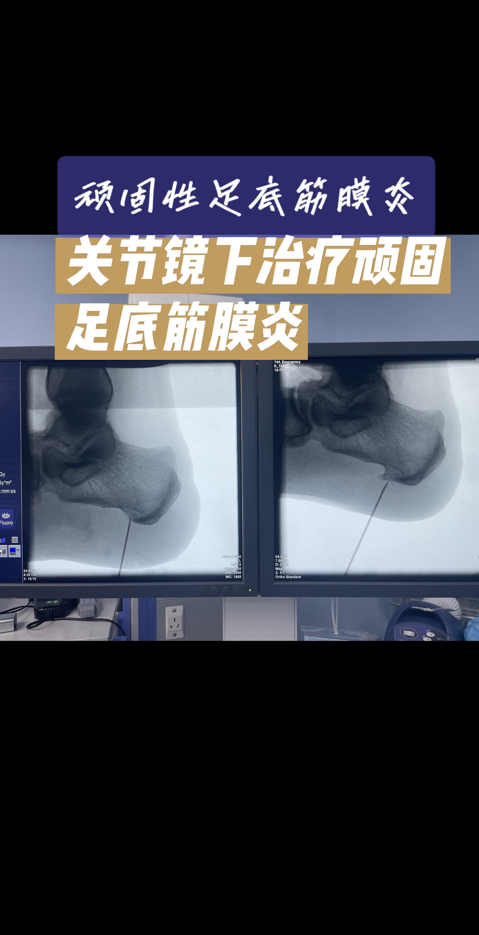 脚后跟像踩针？一走路就钻心疼？对于忍了好几年，试遍各种方法都没用的‘顽...