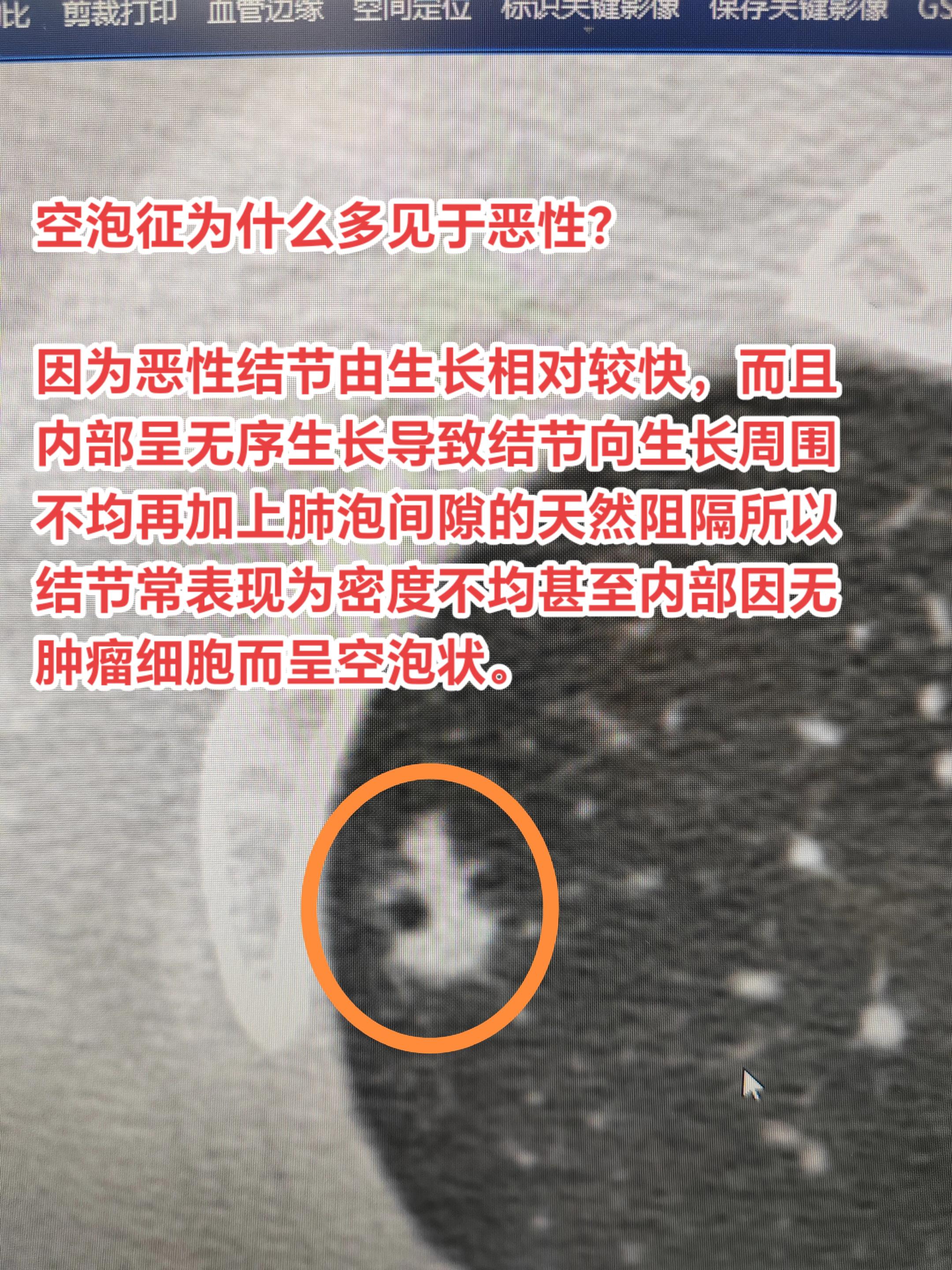 空泡征为什么多见于恶性？因为恶性结节由生长相对较快，而且内部呈无序生长...