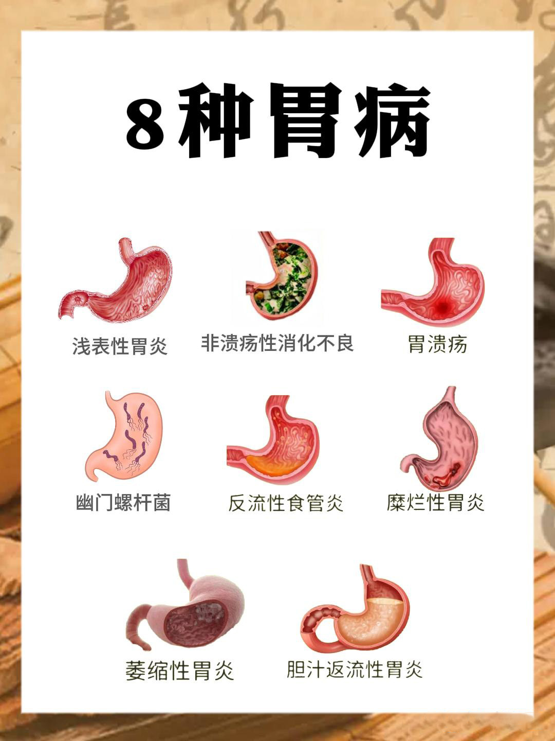 胃炎胃溃疡中医怎么调理？急性胃炎，邪实为主，宜用吐下慢性胃炎，正虚邪实，治法不一