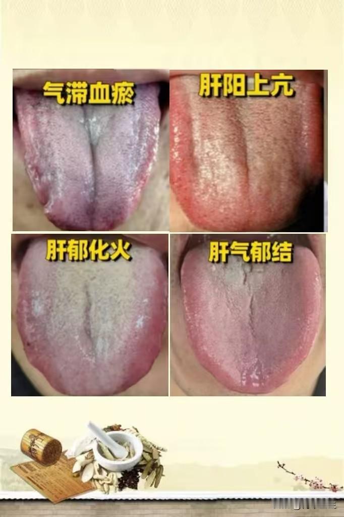 最近几天看诊，遇到几个比较典型的舌象，分享给大家看看，快来对照一下自己的舌头！
