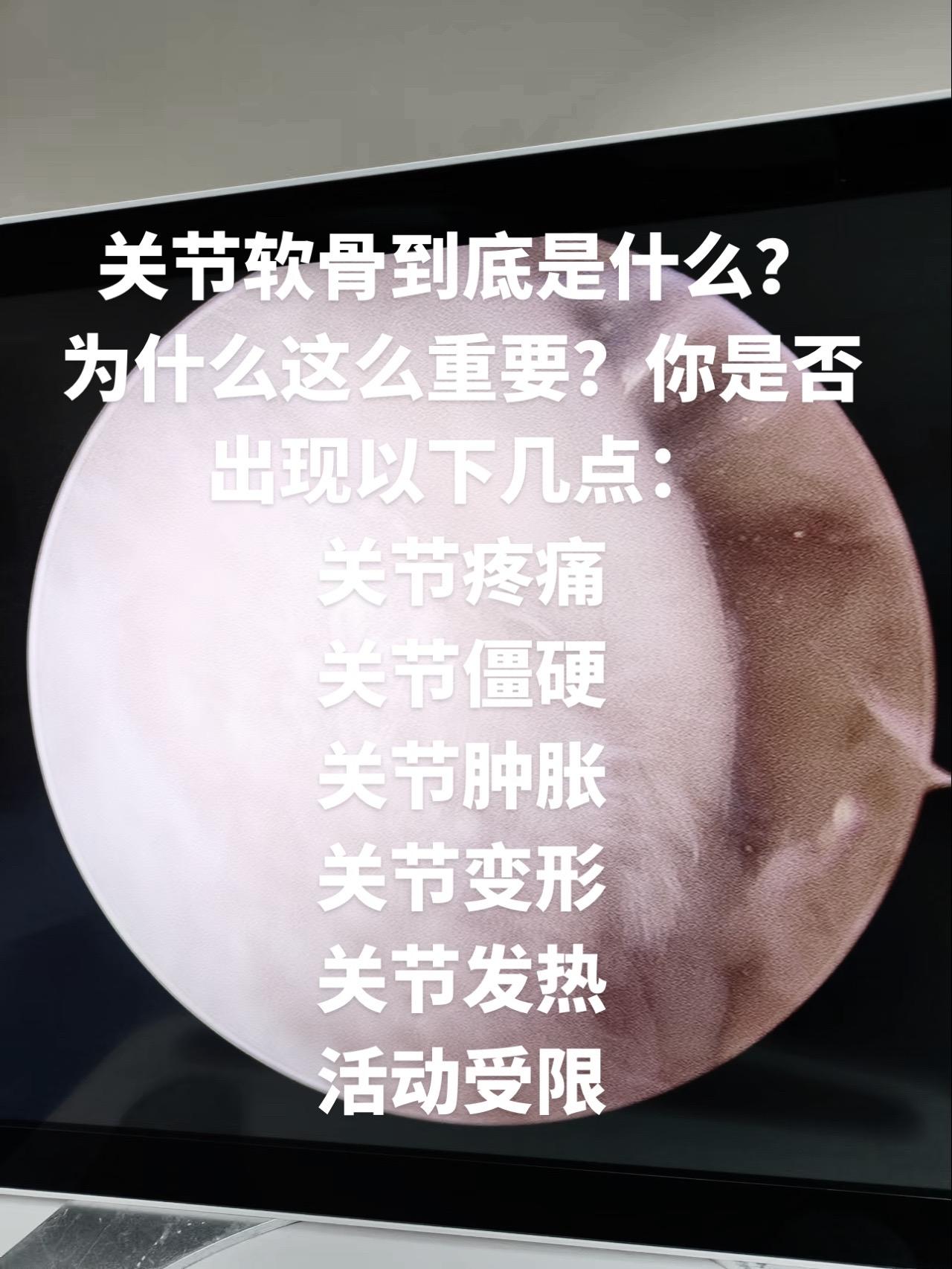 骨性关节炎最根本病变就是软骨磨损。
