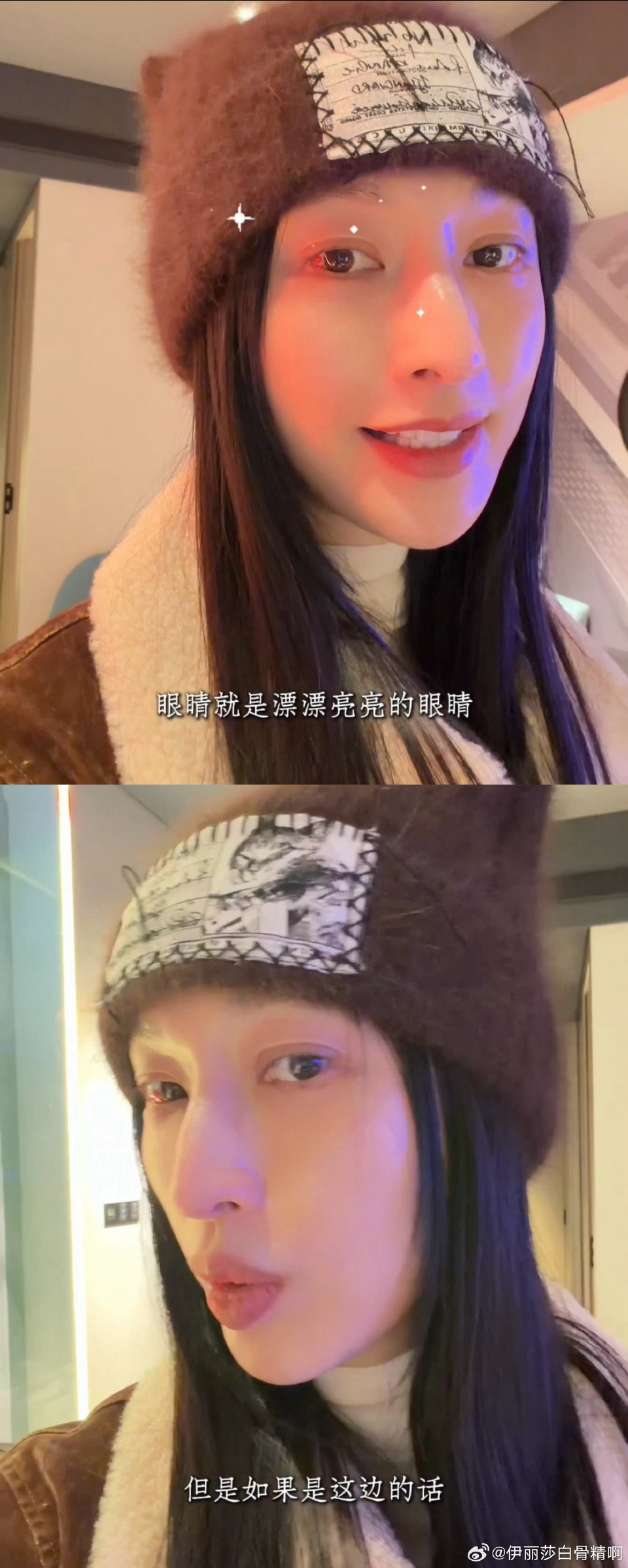 张俪眼睛毛细血管破裂张俪眼睛毛细血管破裂还坚持认真工作，看着既心疼又佩服，敬业的