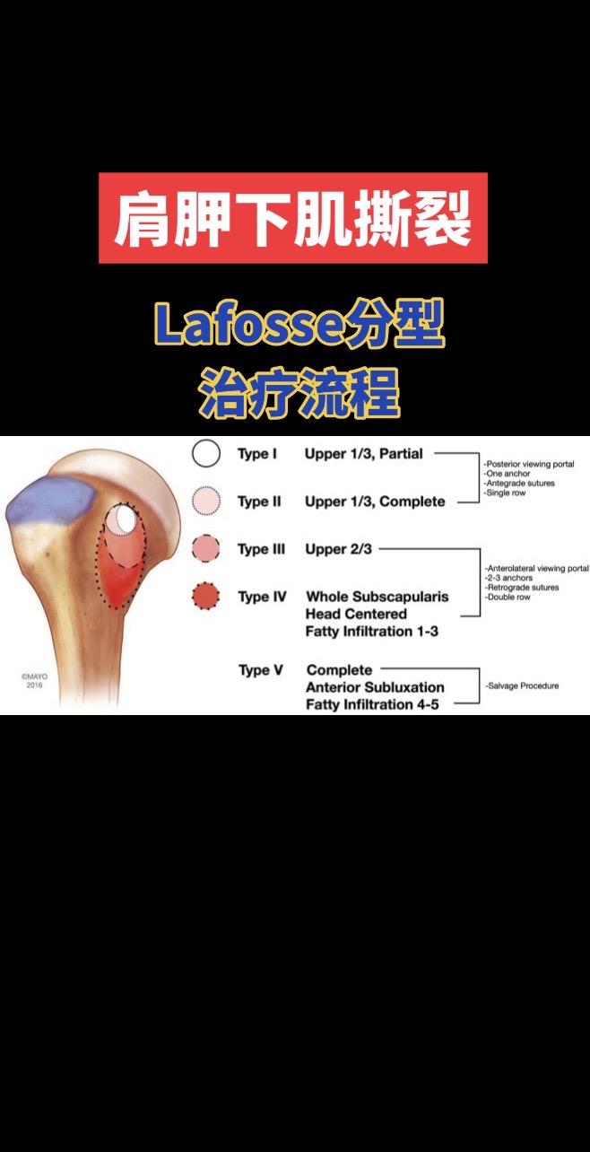 肩胛下肌撕裂Lafosse分型。肩胛下肌撕裂Lafosse分型｜从保守...