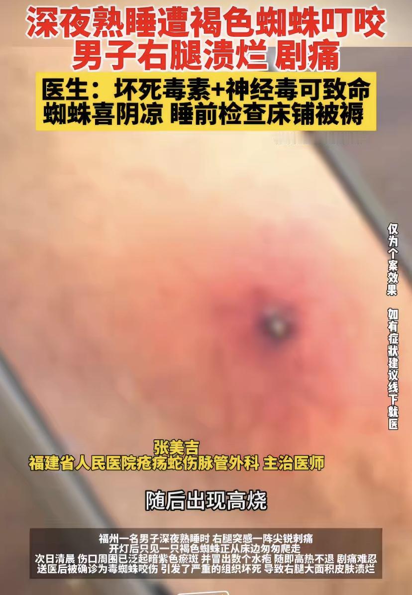 福建男子睡梦中遭“床底刺客”突袭，大腿烂出大窟窿，医生紧急提醒!
福建福州最近出