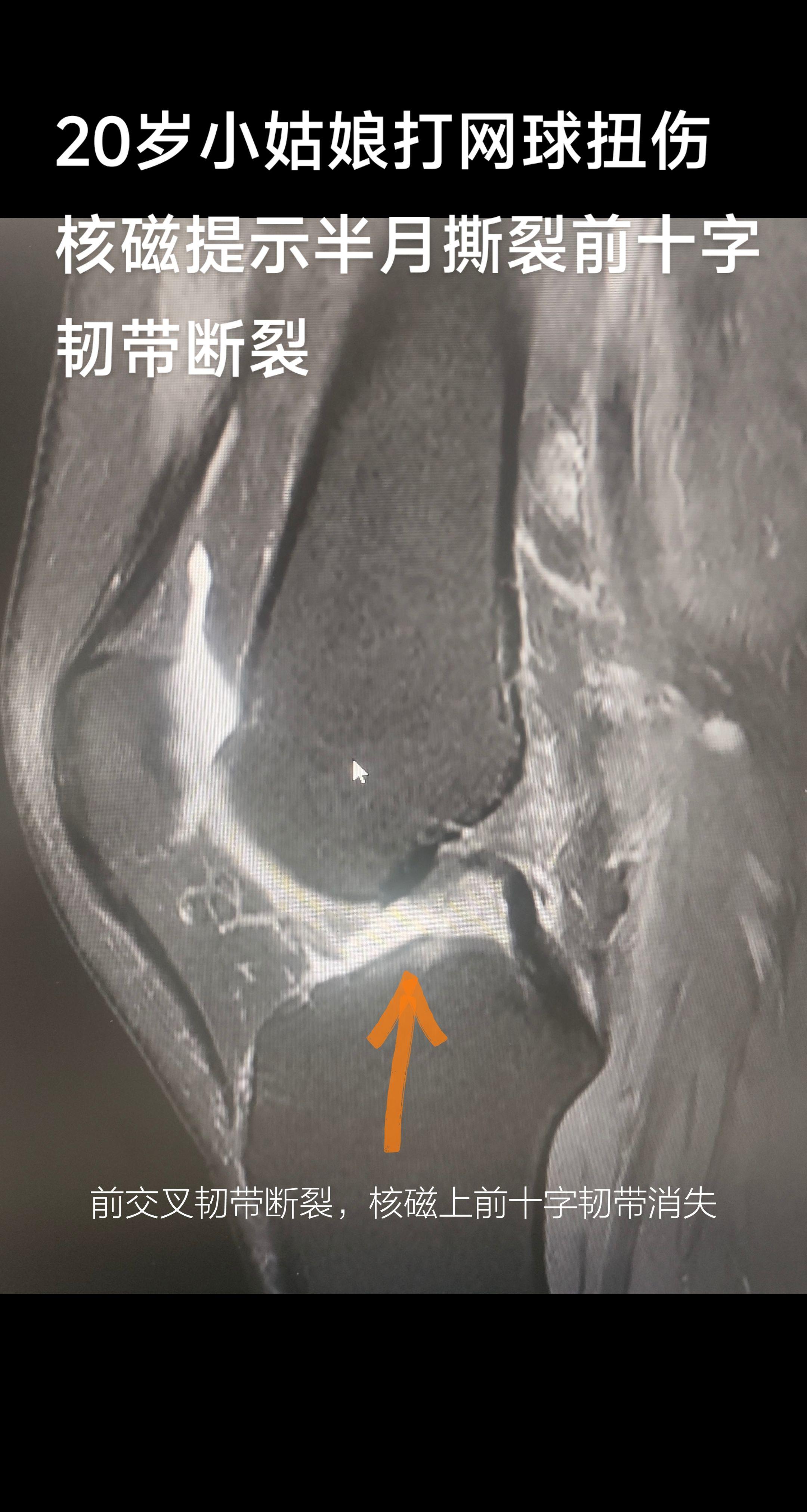 膝关节前十字韧带重建+半月板缝合。