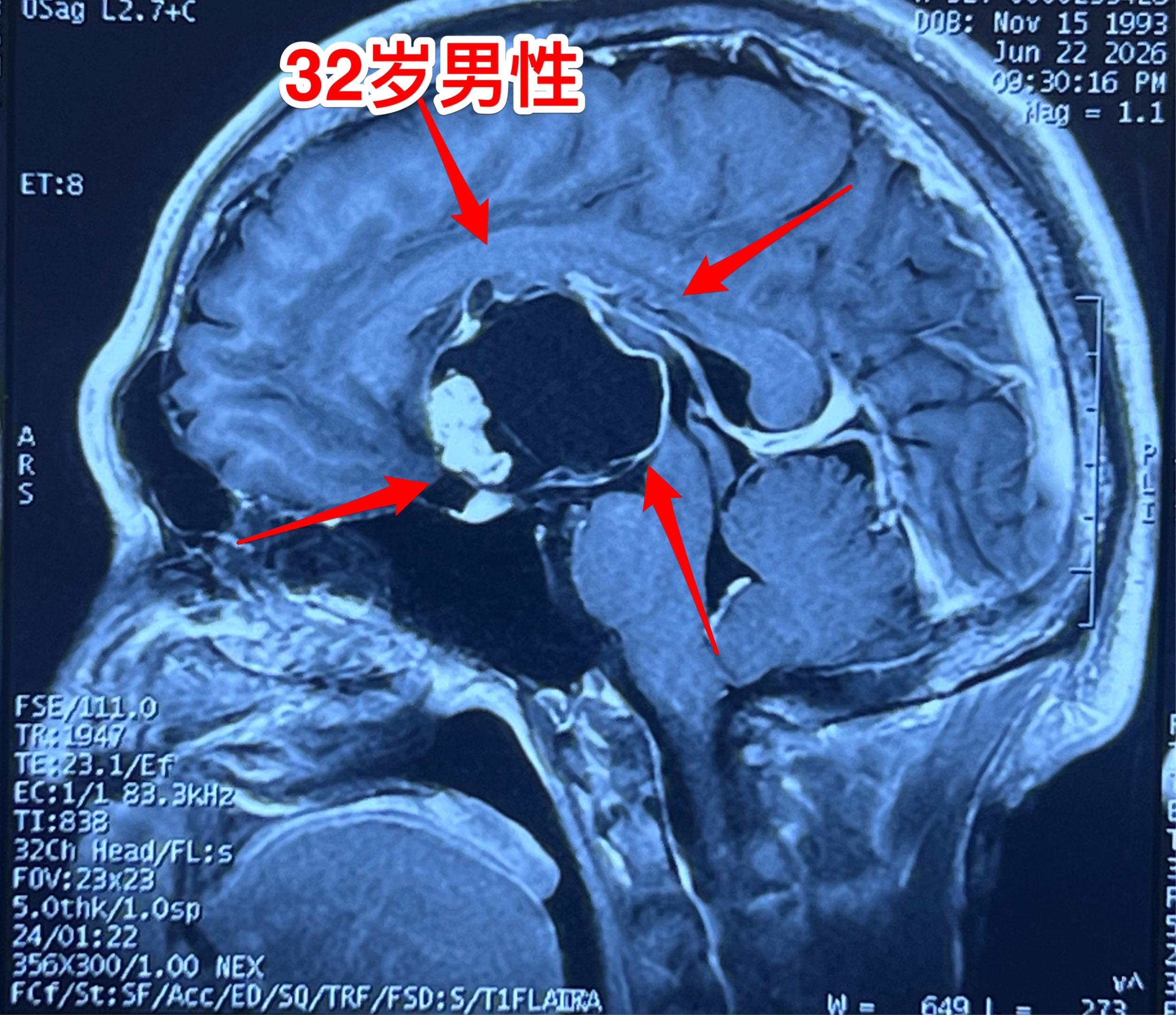 建党节为藏族同胞解除顽疾。这个32岁男性是四川阿坝地区藏族同胞。   ...