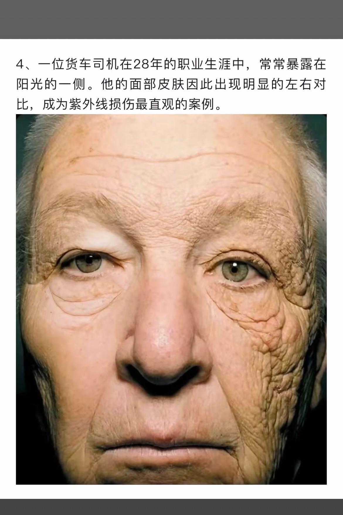 “28年日晒，紫外线损伤的直观案例”📸👨‍🦳