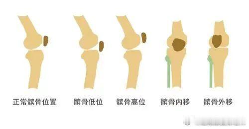 髌骨软化症  前两天讲到髌骨软化，有朋友提问高位髌骨怎么办？今天咱们就来科普讲讲