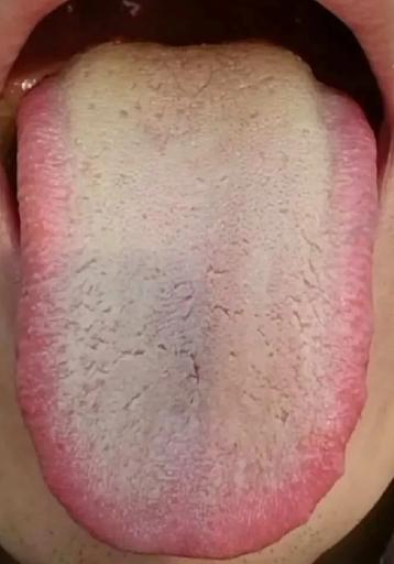 常年手艺活，还觉得没给自己带来伤害，张医生通过一则案例给大家讲讲手艺活带来的危害