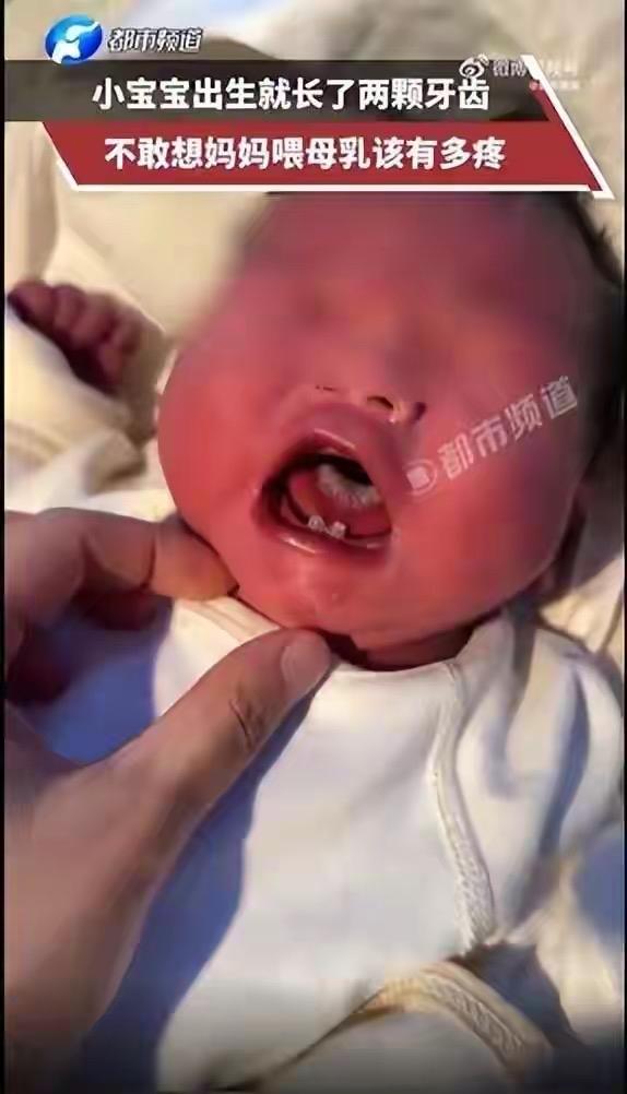 山东一婴儿刚出生嘴里就长着两颗牙，网友：不敢想妈妈喂奶该多疼！

医生提醒近日，
