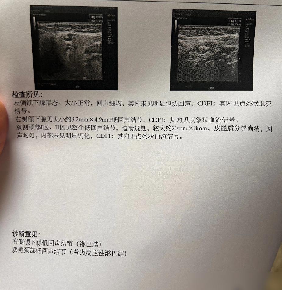 起因是一周前自己喉咙痛，然后觉得右侧脖颈都不舒服，摸来摸去摸到右侧下颌有个硬疙瘩