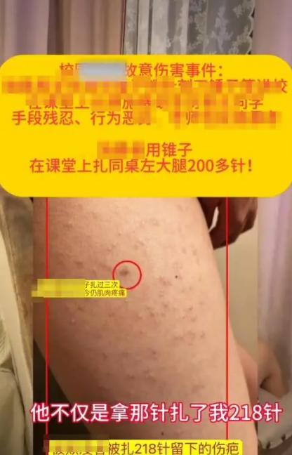 “我真的想死在学校里面！”山东济南，一名六年级女生遭同桌男生用铁锥残忍戳刺，大腿