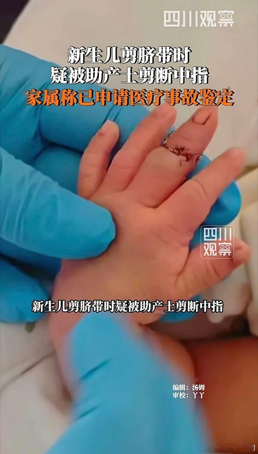 新生儿断指处有钢针日夜哭闹都不敢看！小宝贝太可怜了！