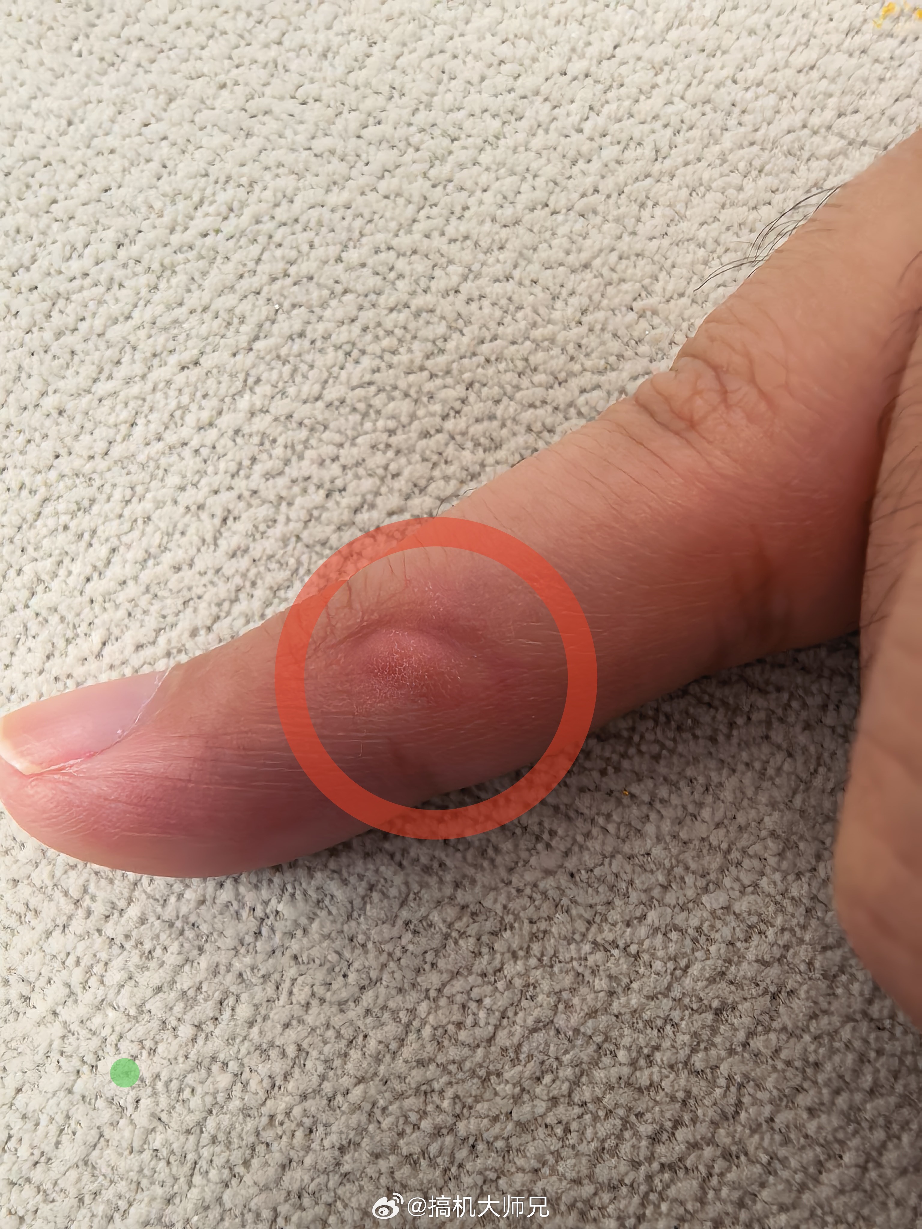 突然发现小拇指起了个疙瘩，仔细一想好像是单手拖着玩手机，在充电口那卡出来的