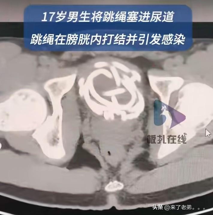 17岁高中男生因好奇将跳绳塞入尿道，跳绳在膀胱内相互缠绕成死结，尿道已出现严重感