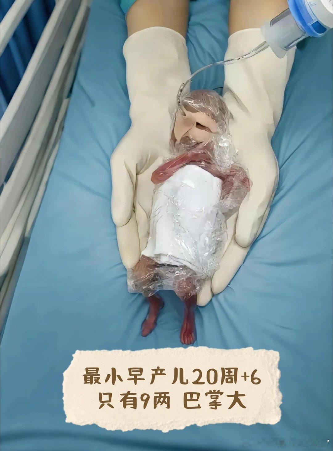 全国最小，20周的早产宝宝，只有9两，还没有个巴掌大！加油宝贝！愿平安健康的长大