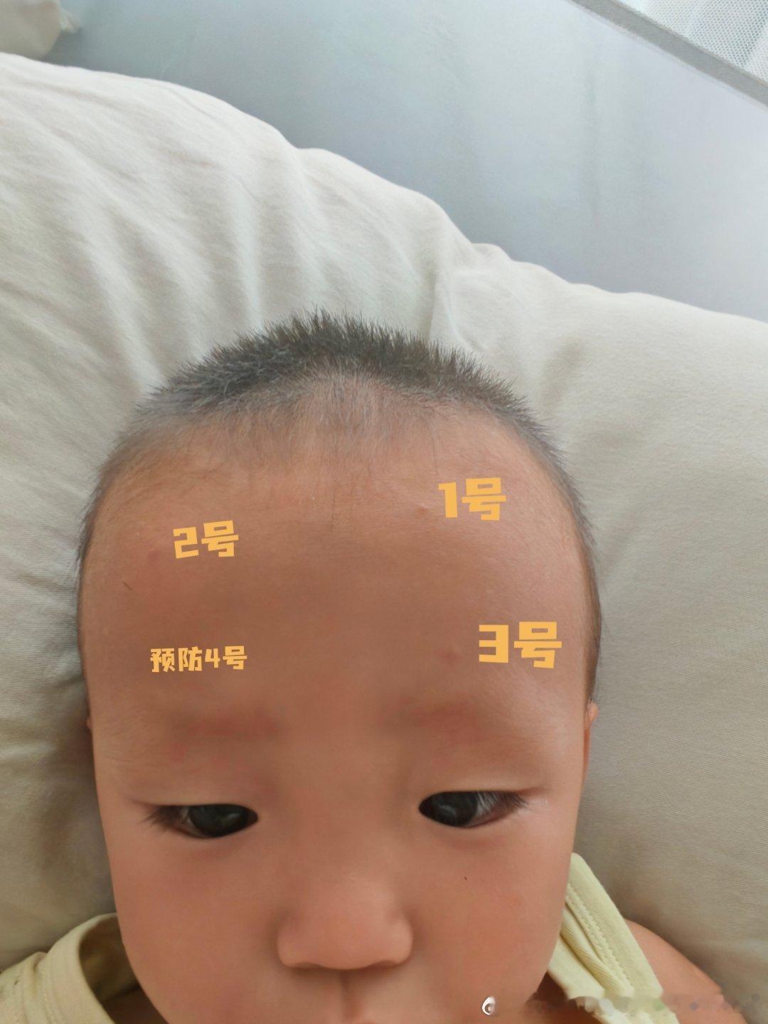 今天我和他说你看笑笑这额头可能因为小孩脑门面积大每次涂驱蚊的也不会涂脸上就被蚊子