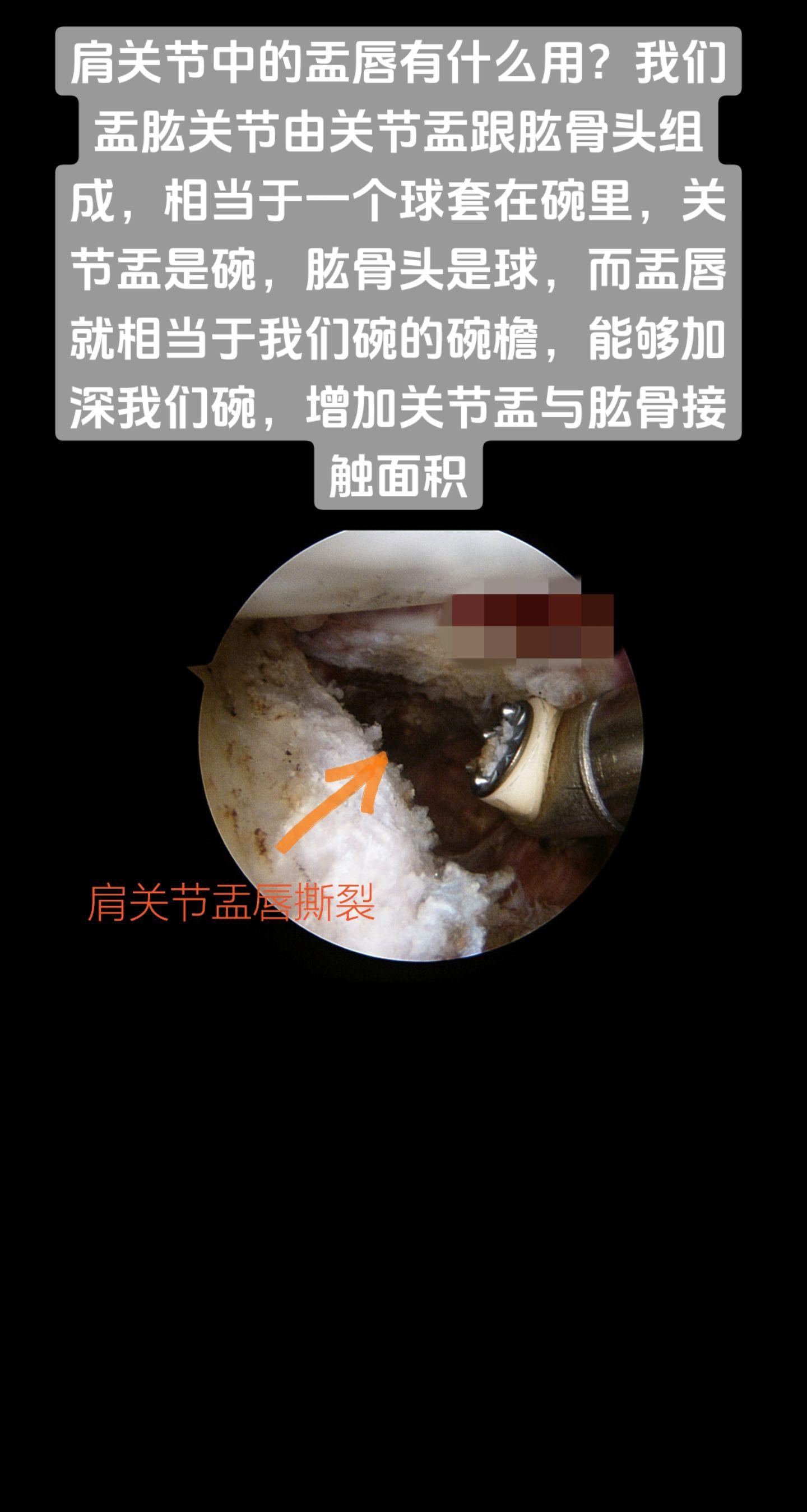 肩关节盂唇撕裂。