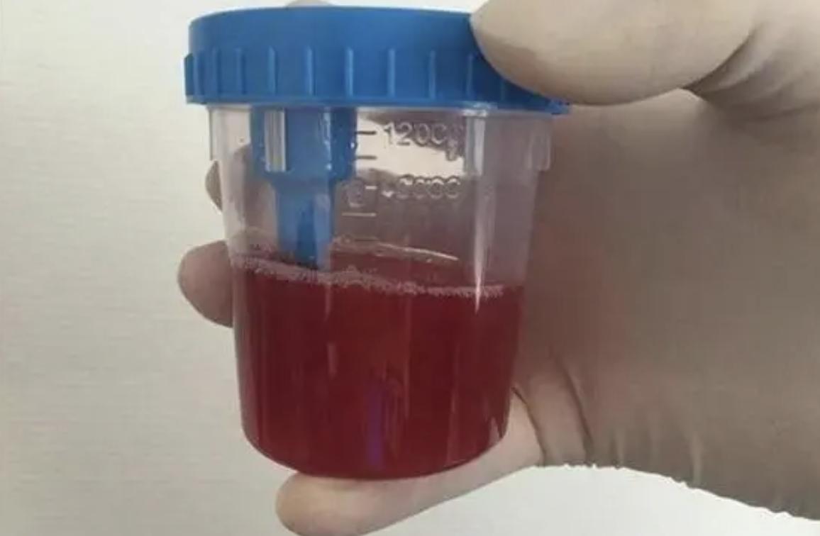 我女儿6岁了，刚上一年级，今早她上厕所，忘记冲厕所了。我去卫生间看到马桶里有血丝