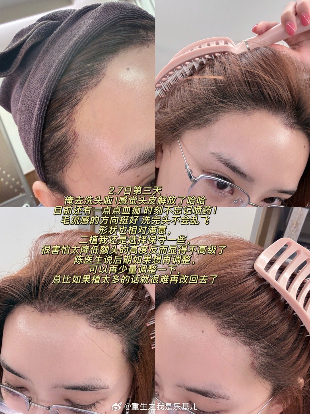 俺的植发plog 二植成功上岸我发现身边很好看的女生朋友都对植发有很深的执念二植