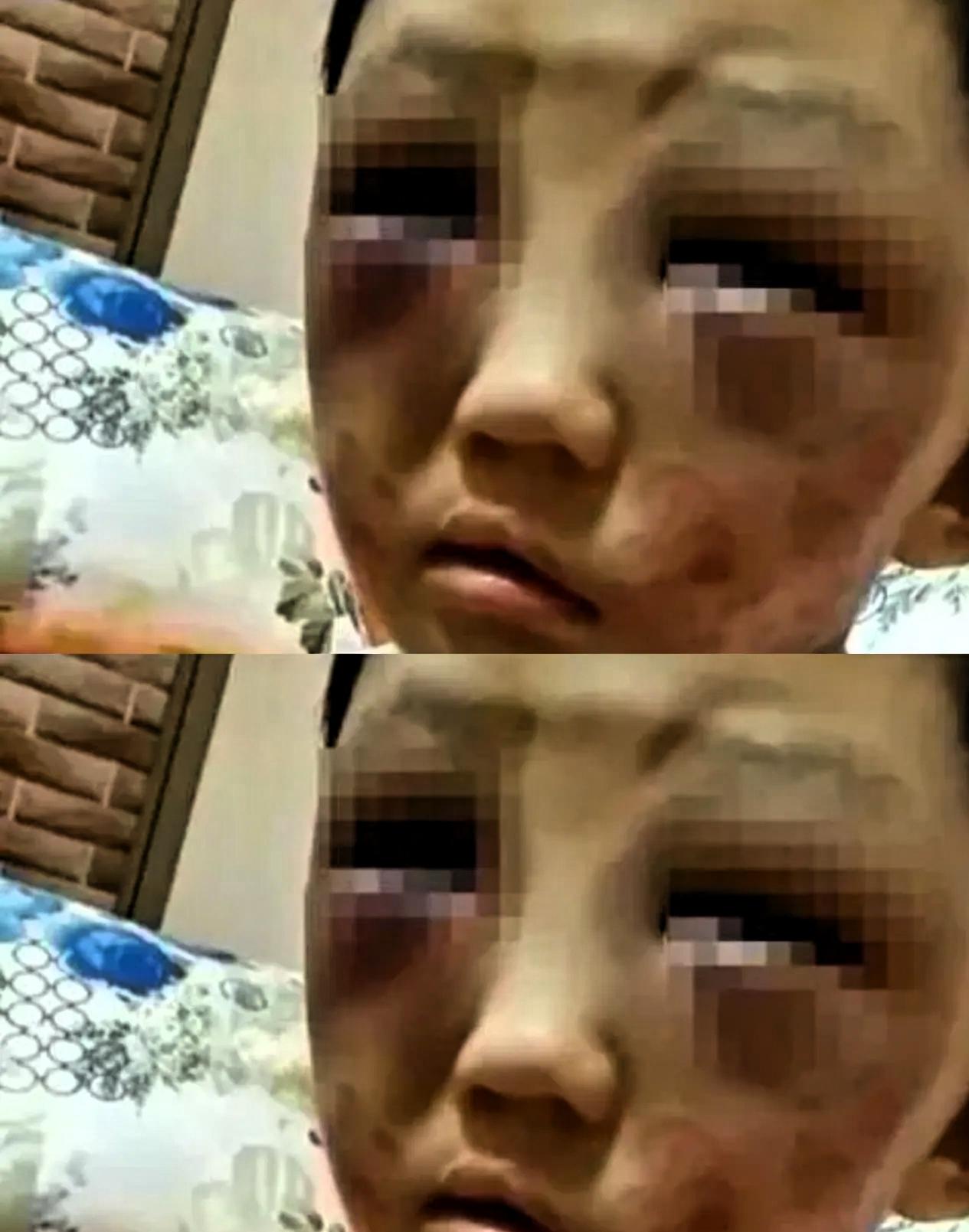 才6岁的娃，硬是靠两条小短腿走了一整天。一路奔波回到妈妈身边。当衣服掀开，身上的