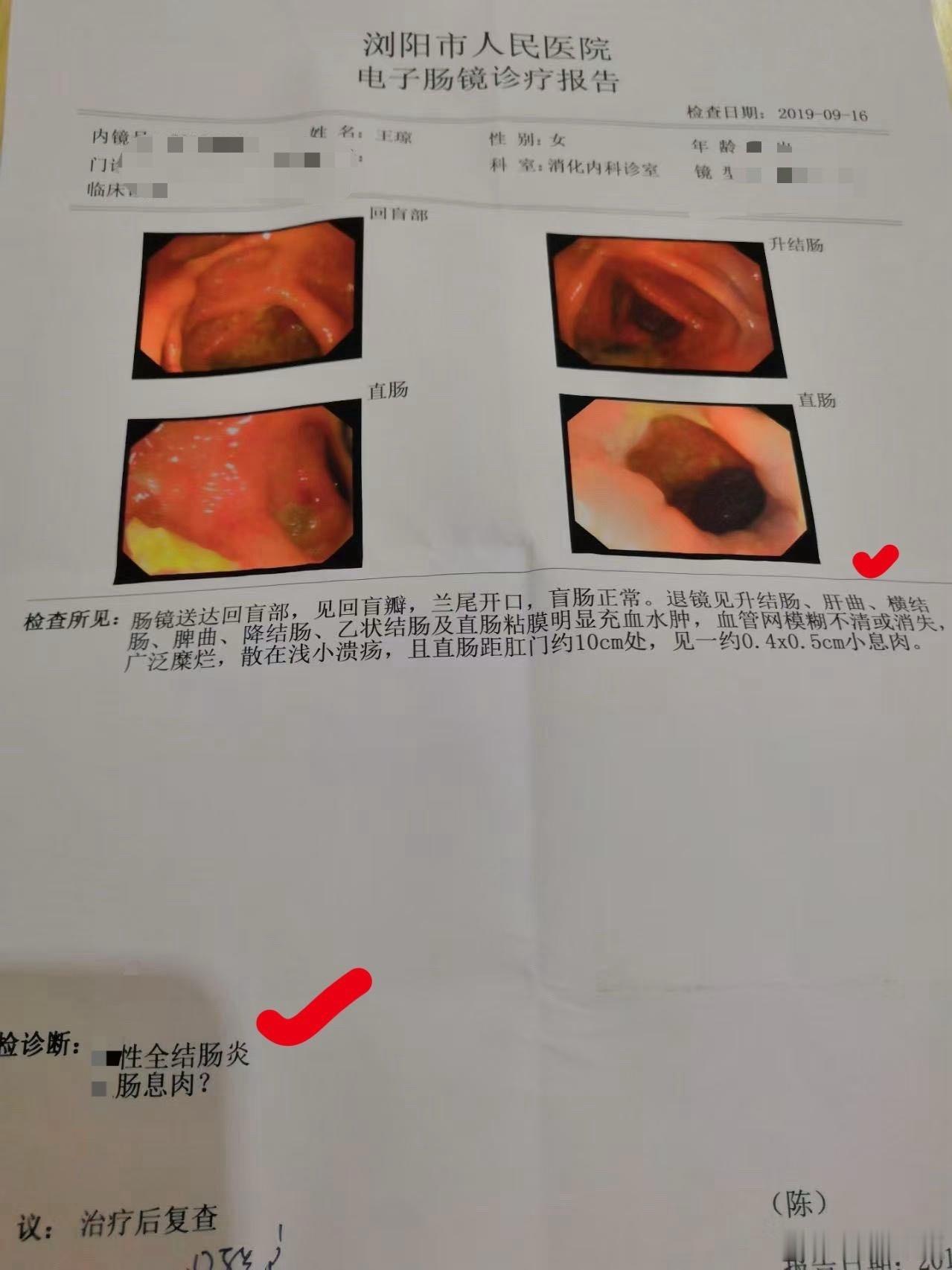 治疗溃疡性结肠炎，温阳很重要。今天收到一个病人肠镜复查的结果，乙状结肠、直肠还有