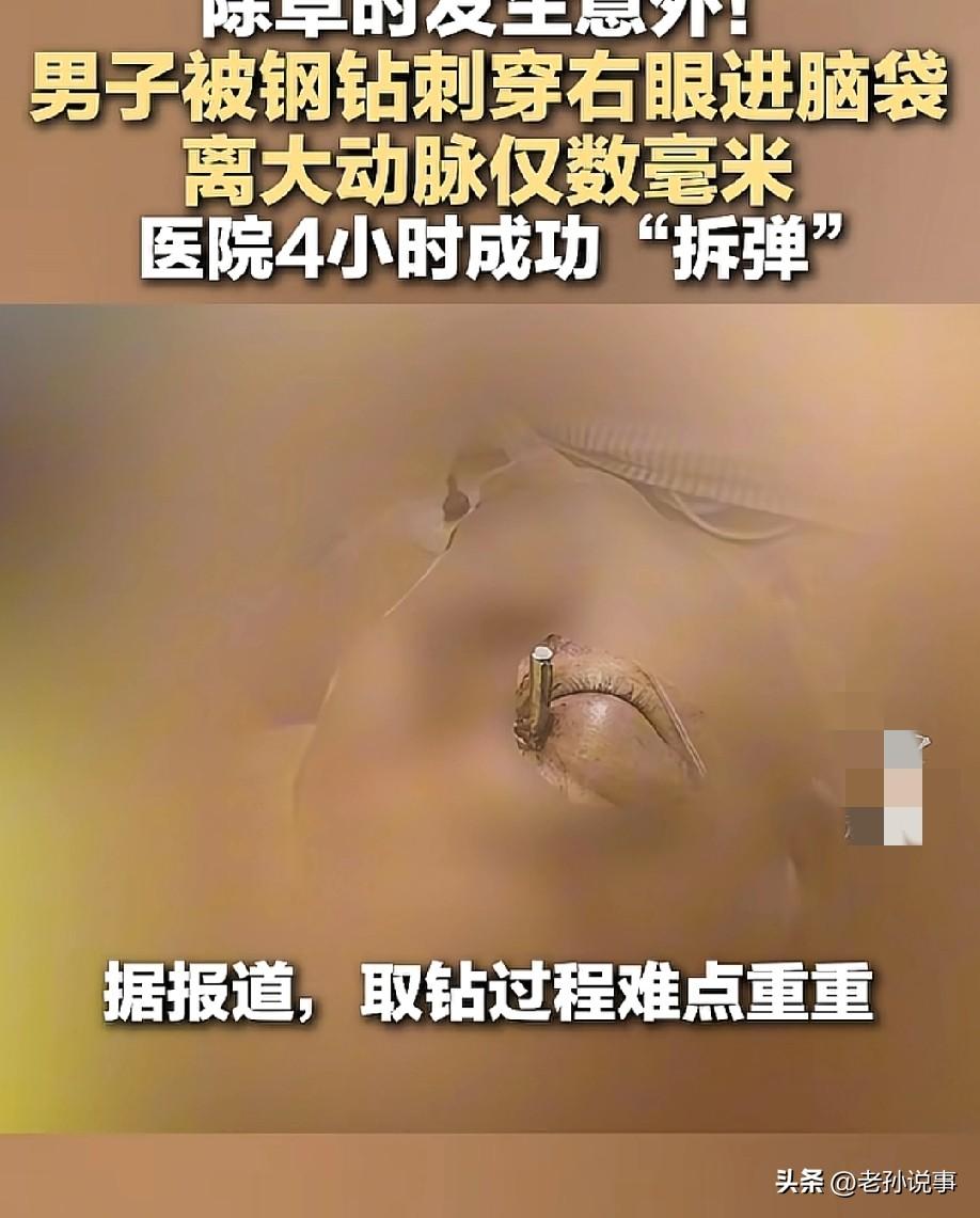 头皮发麻！佛山，一名48岁男子除草时被18厘米钢钻刺穿右眼贯穿颅脑，离大脑中动脉