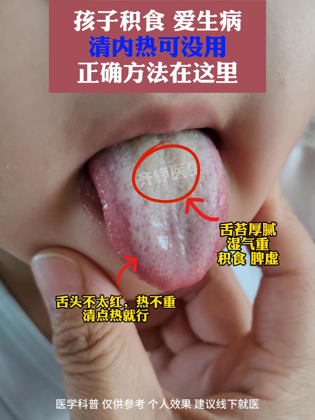 孩子积食生病，清内热可没用，正确方法在这。这个舌苔，最大特点就是厚腻...