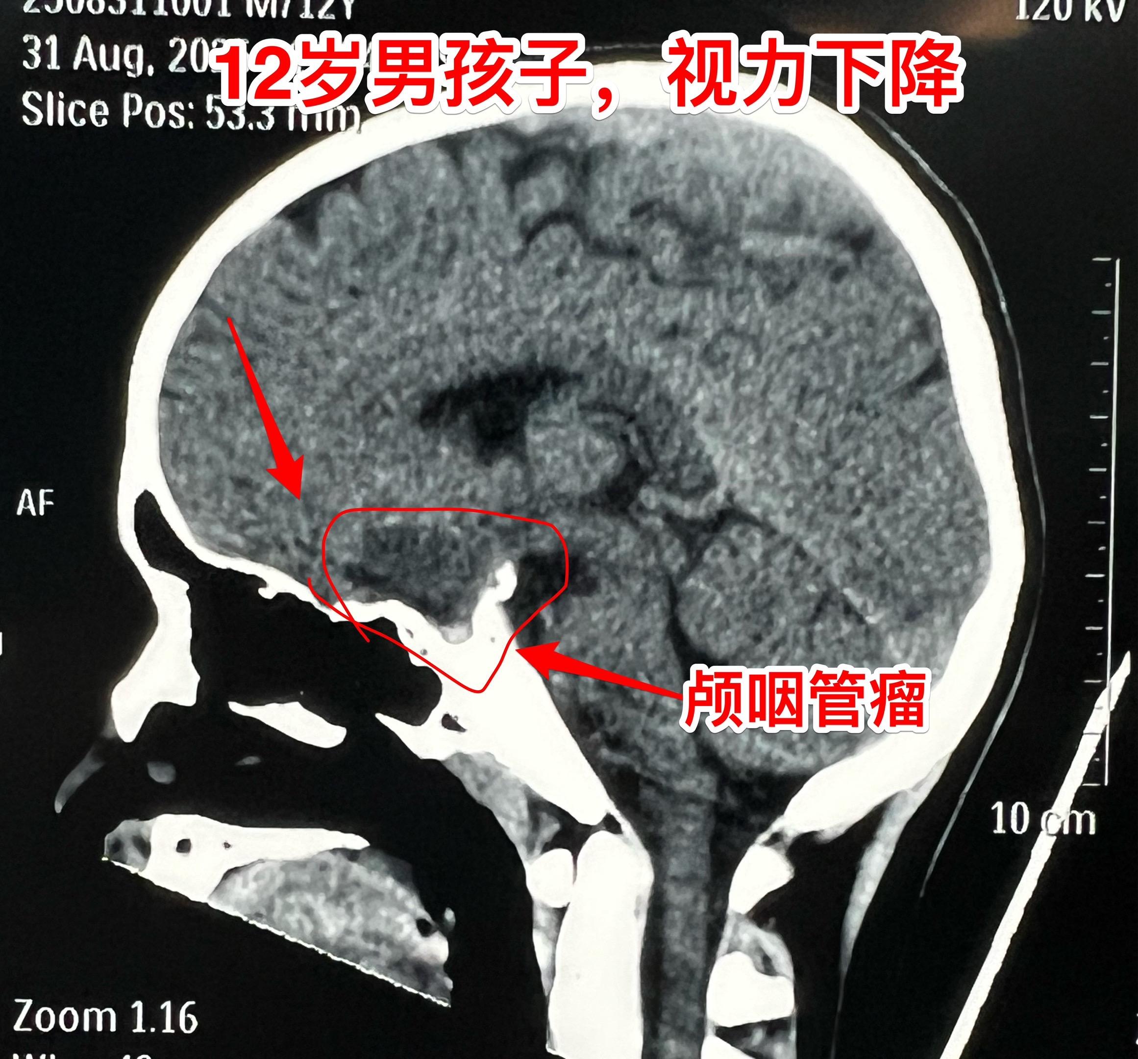 常规一天两个颅咽管瘤手术。今日两个颅咽管瘤手术。         上午...