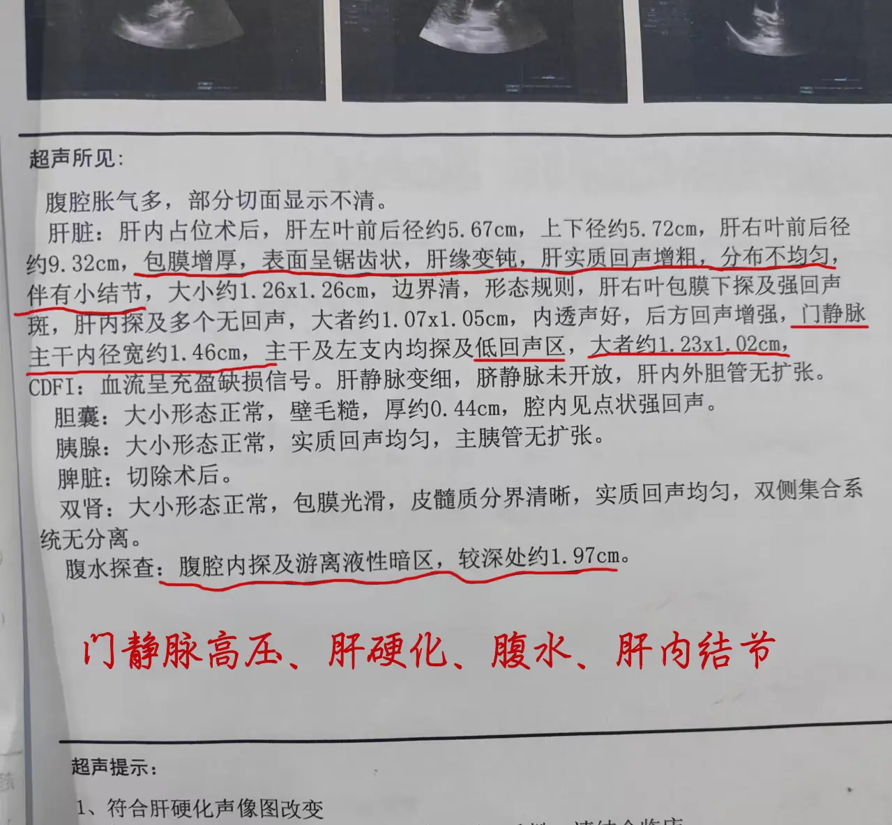 希望大家的彩超永远没有这些提示 正常人的肝脏彩超提示的是肝脏形态正常...