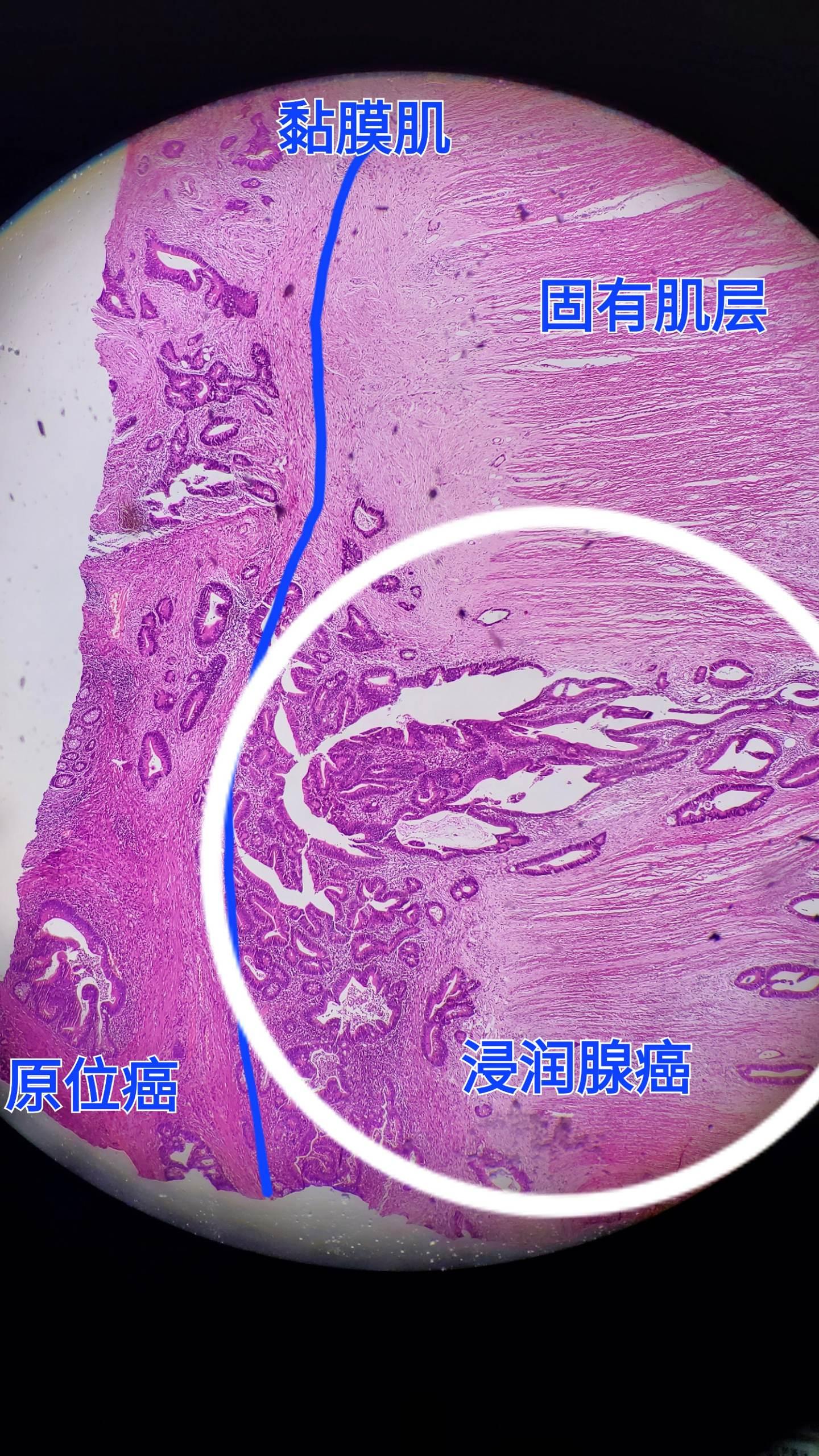 肠腺癌