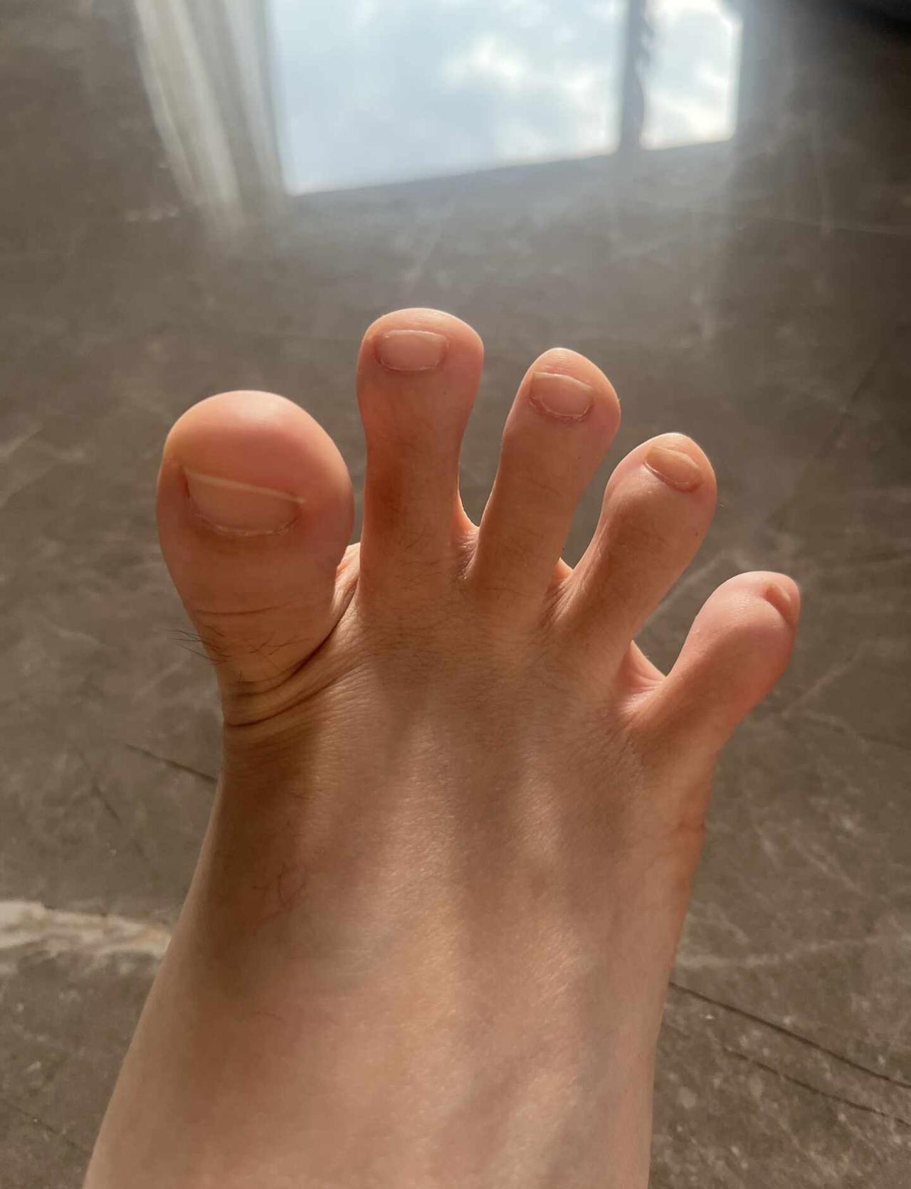 可以看下这算是脚趾开花么
大拇指一直往上翘的
欧阳春晓 足弓 力线