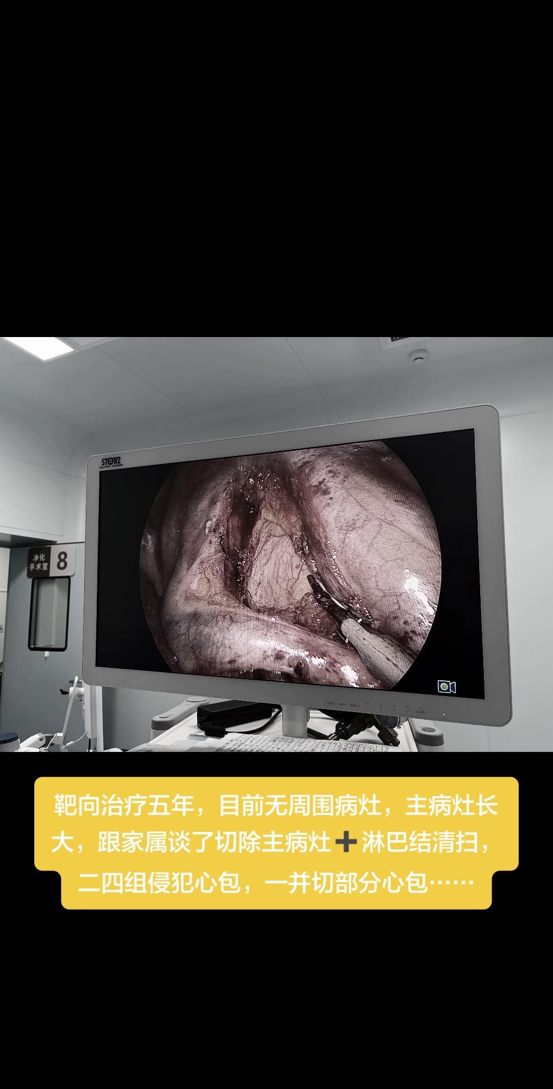 靶向治疗五年，目前无周围病灶，主病灶长大，跟家属谈了切除主病灶➕淋巴结...