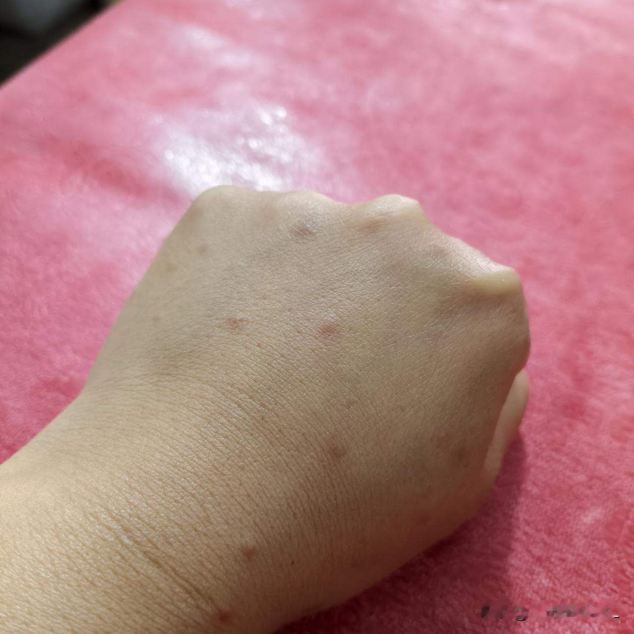当我困惑不已不知道怎么办的时候便想到了它。被蚊子咬了三天了，不见好，还长出新的包