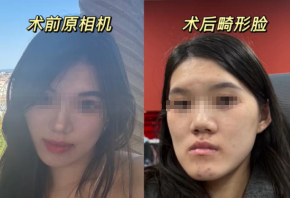 离谱！24岁女孩微调2毫米地包天，医生做反手术直接变鞋拔子脸。

这事发生在武汉
