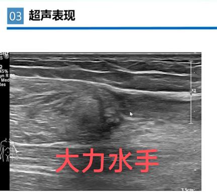大力水手征。肱二头肌长头腱