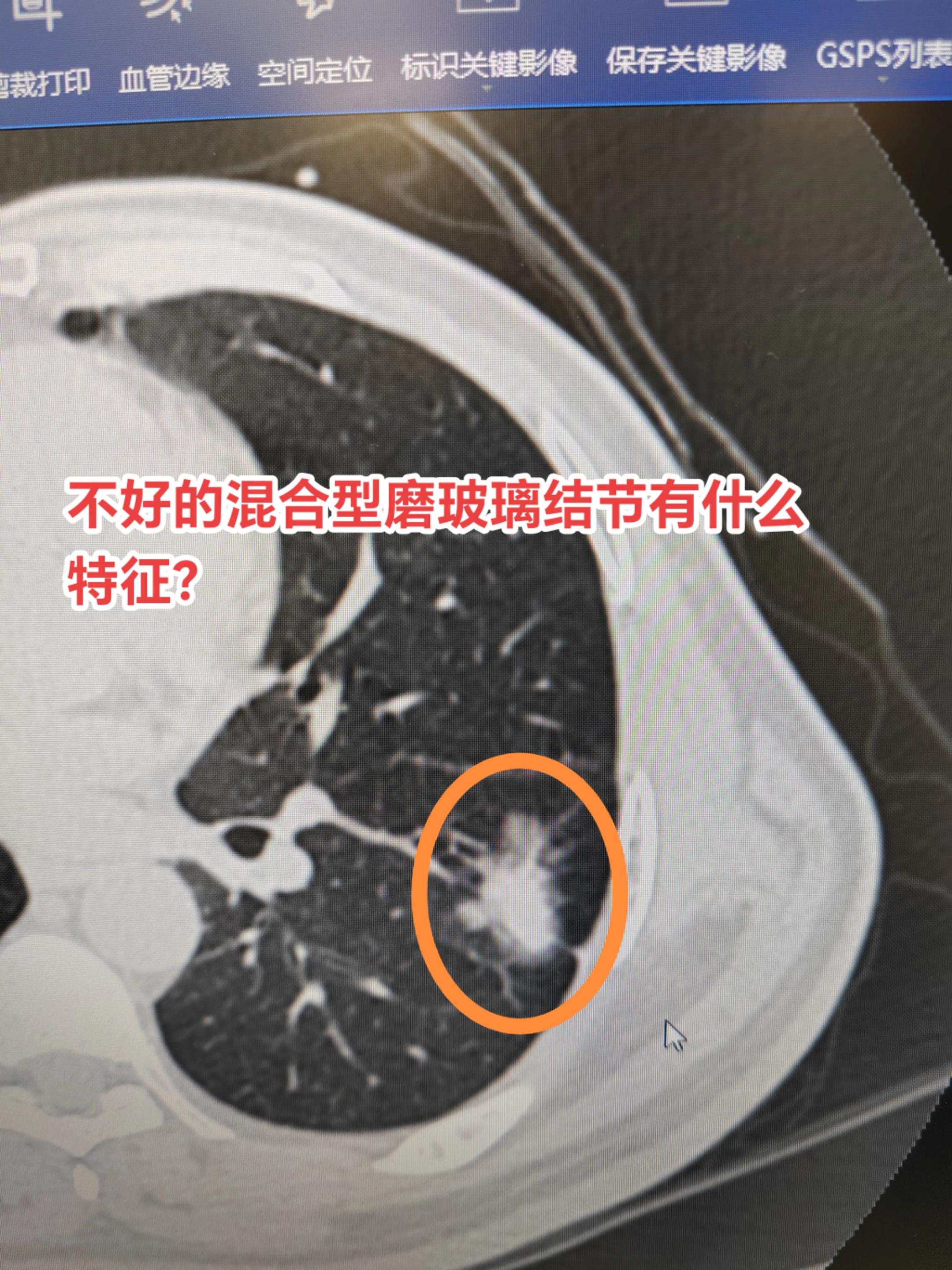 不好的混合型磨玻璃结节有什么特征？混合型磨玻璃结节是指结节内含有实性和...