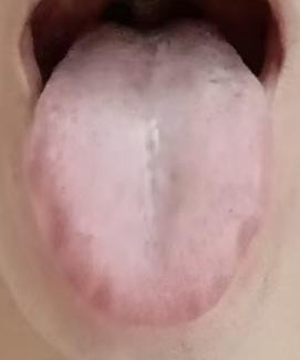 舌尖偏尖、舌苔淡白，伴随思虑过多、大量脱发，这类体质多为肝郁牵连脾虚、气虚所致