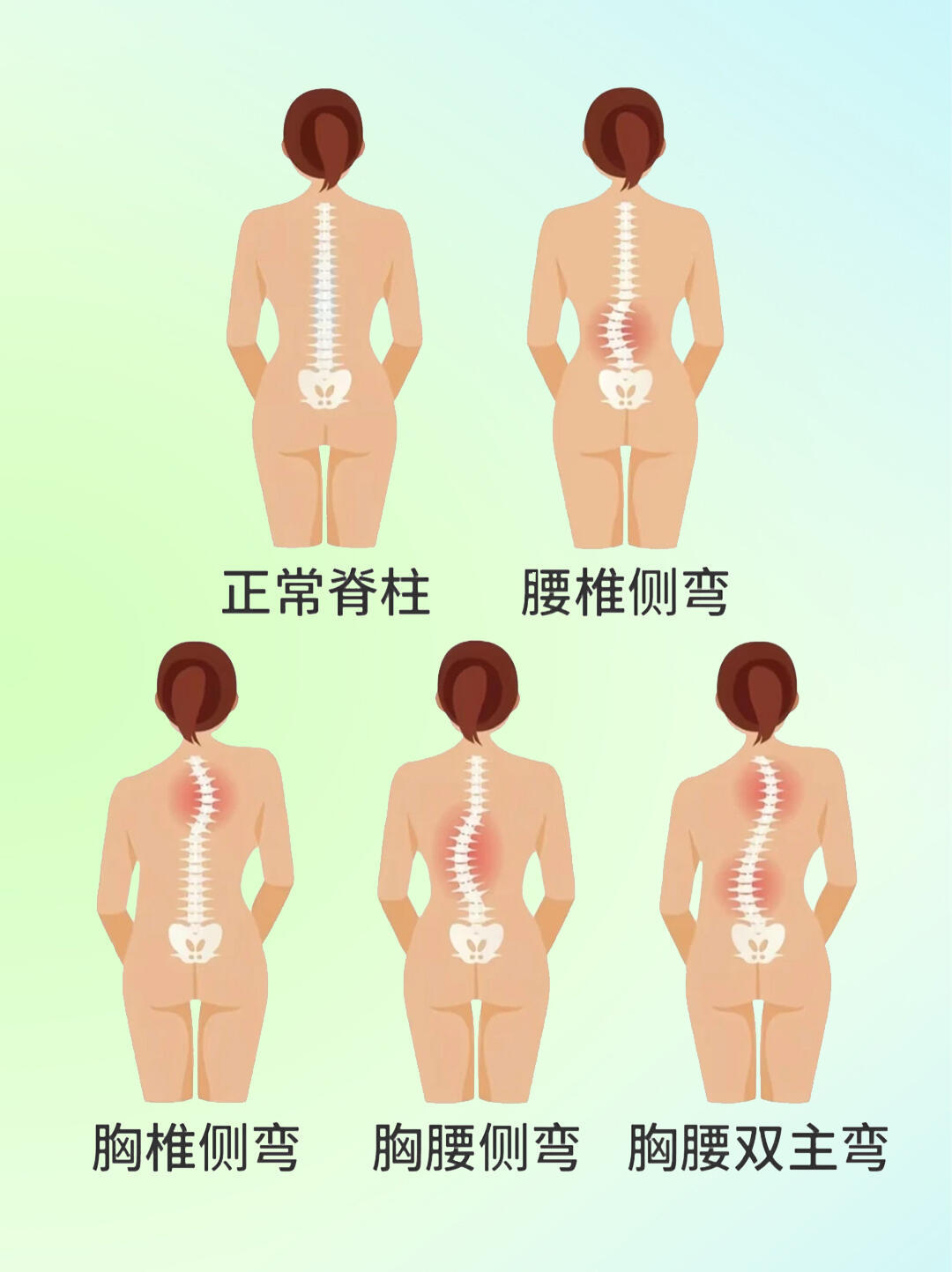 看演唱会发现自己脊柱侧弯了 久坐歪坐易引发脊柱侧弯，高低肩、身形歪斜超显臃肿。日
