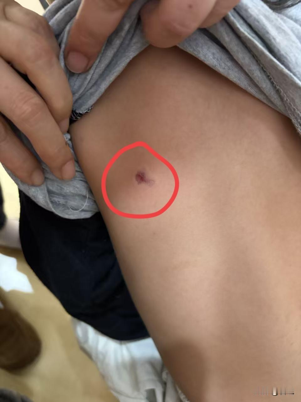 第一次赶鸭子上架处理托班2岁儿子咬人事件，真是又懵又无奈！道了歉，带去看了医生，