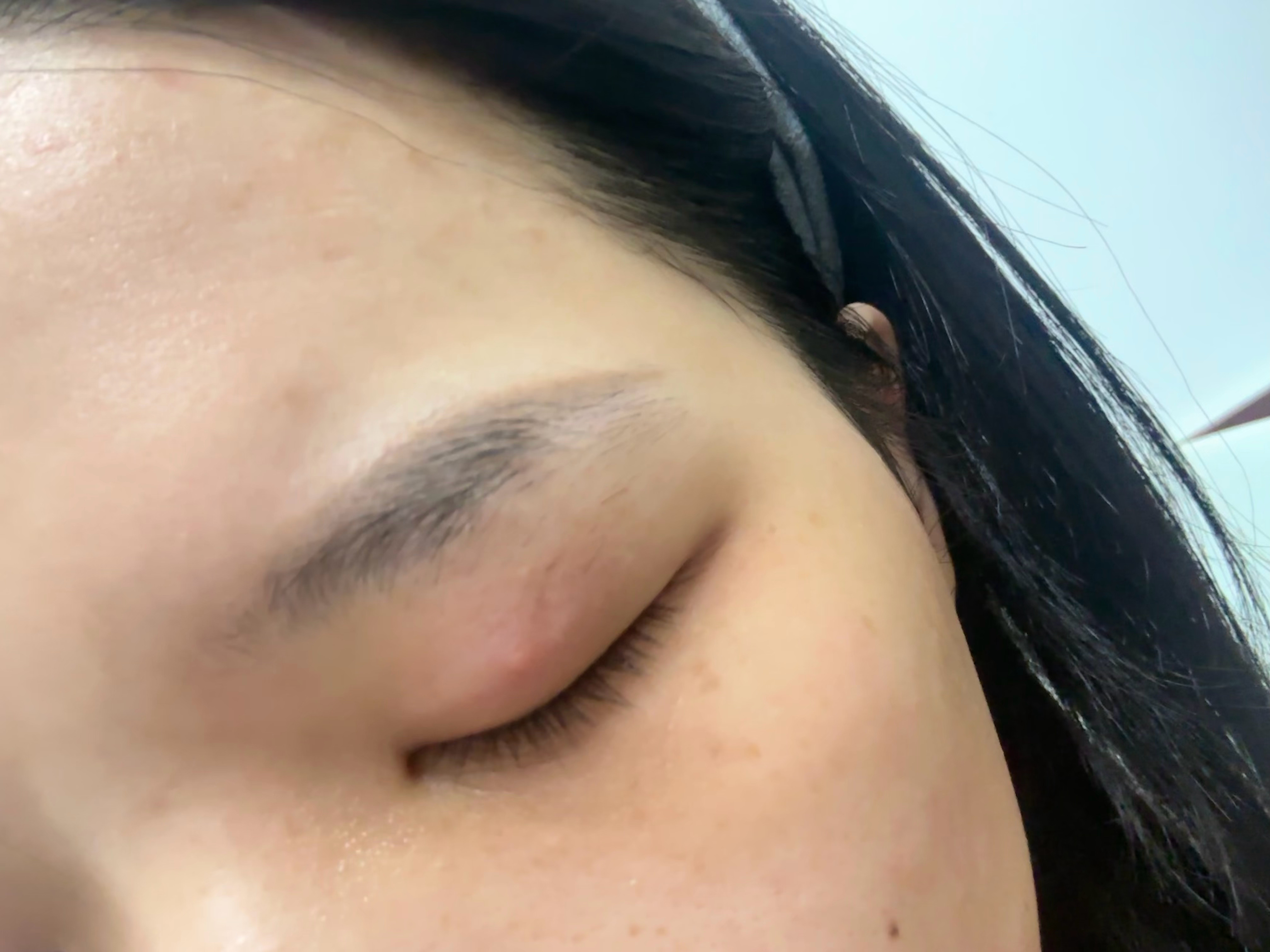 老婆 继被隐翅虫咬之后我眼皮又不知道被什么东西咬了又毁容了