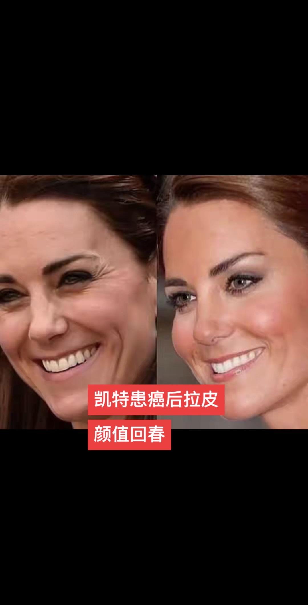 #英王室#凯特王妃#安妮海瑟薇 #拉皮手术 #拉皮去皱