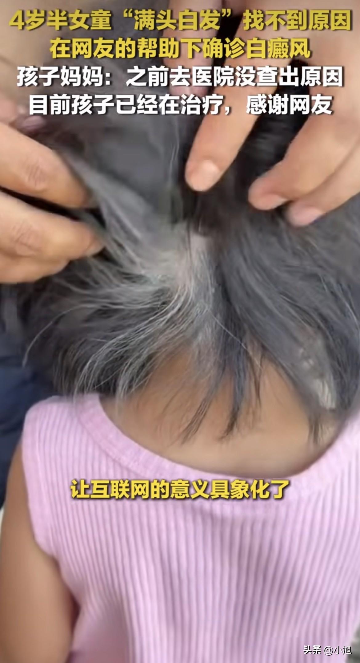 4岁半的孩子，头发全白了。不是几根。是满头。一个幼儿园小孩，顶着一头白发。

当