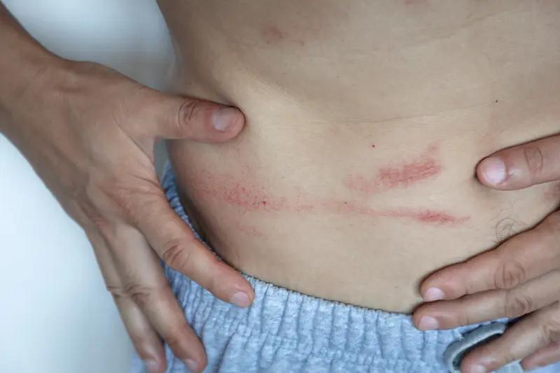 带状疱疹多久能好真因人而异。一般来说，大多能在2 - 4周基本好转。像疱疹消退相