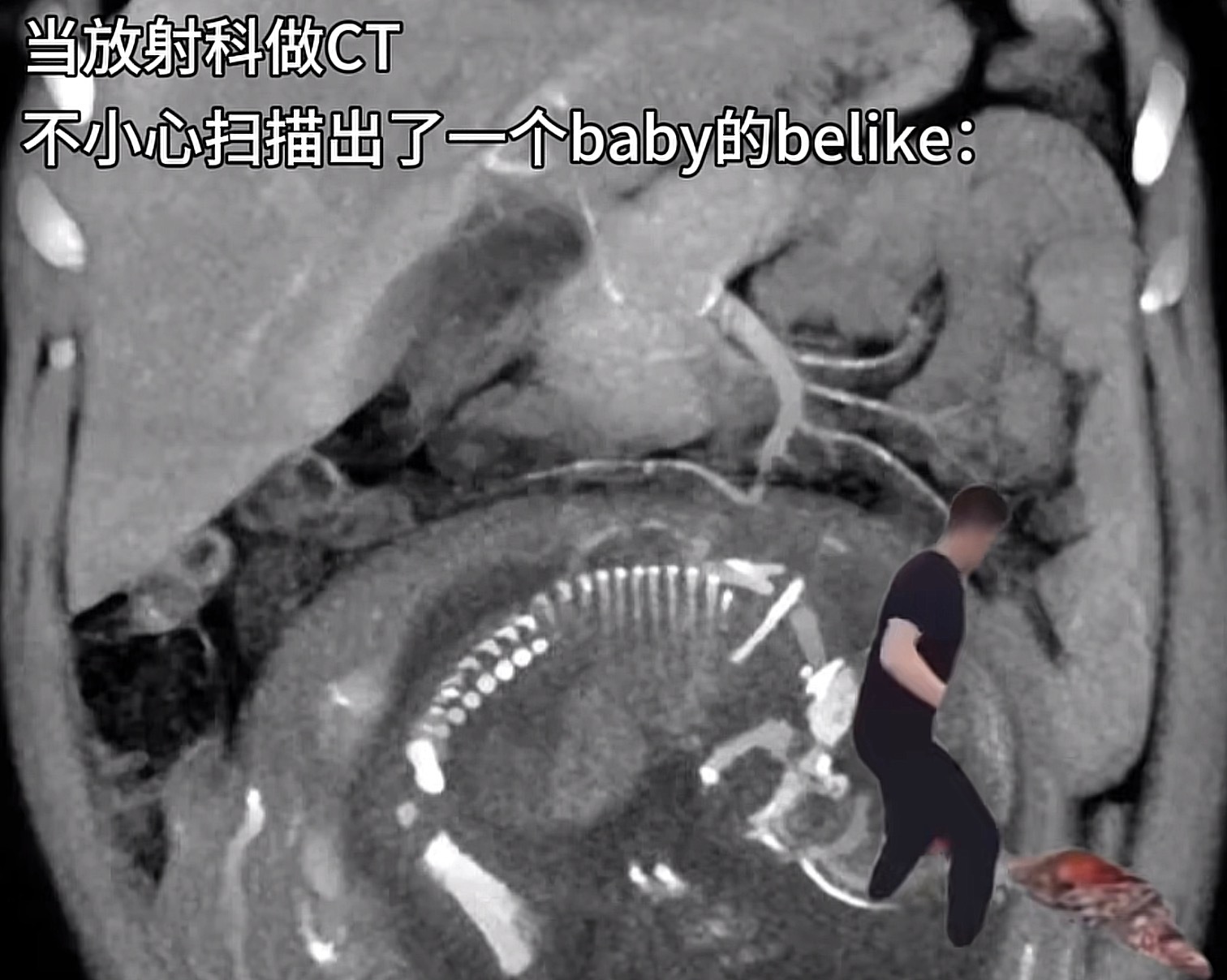 放射科医生名言：宁愿片子上看到吓人的鬼，也不想看到胎儿的腿！退退退⚡ 
