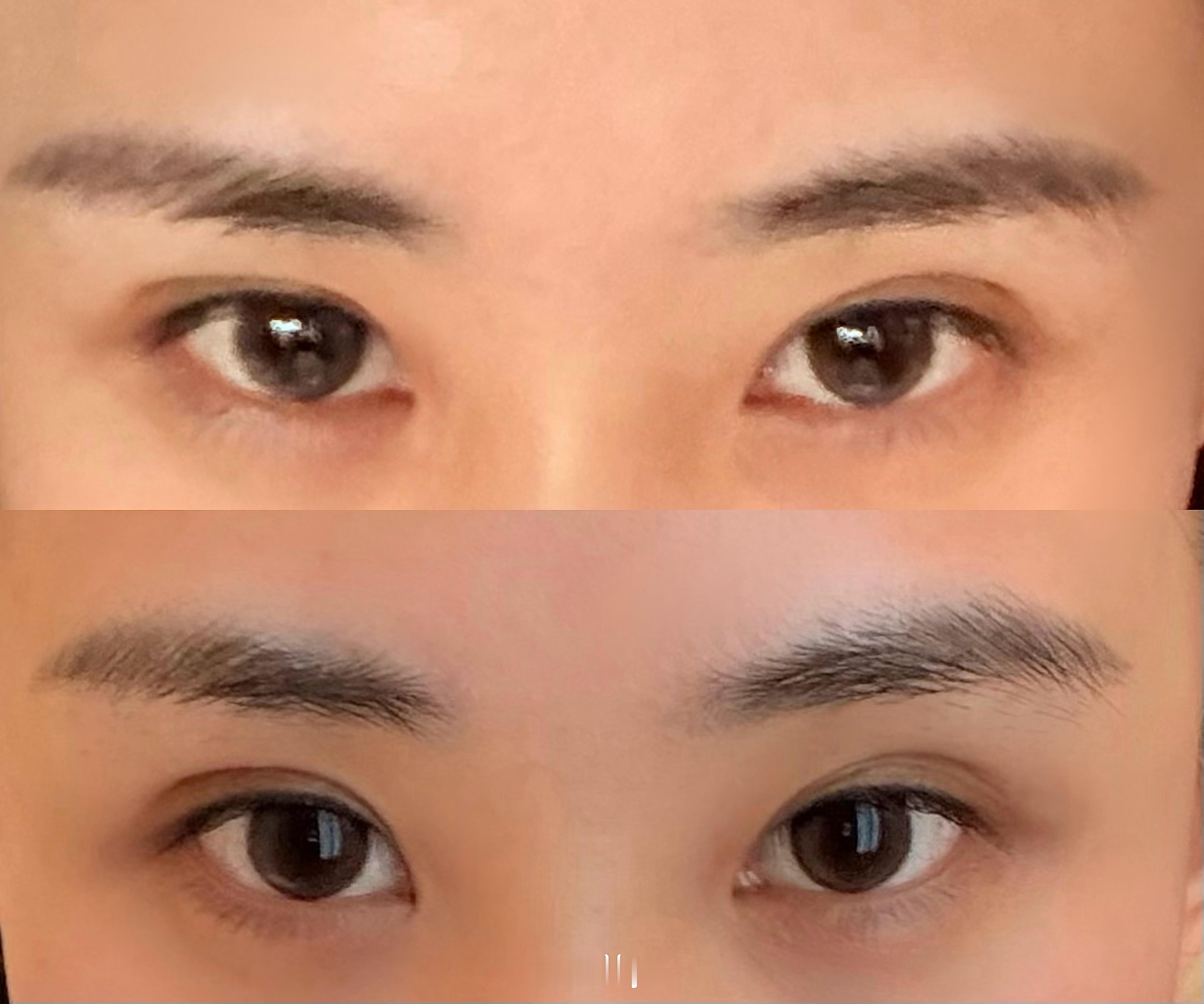 凯思米做了emface效果好好眉压眼肌无力都改善了像做了额头提升+提肌手术关键是