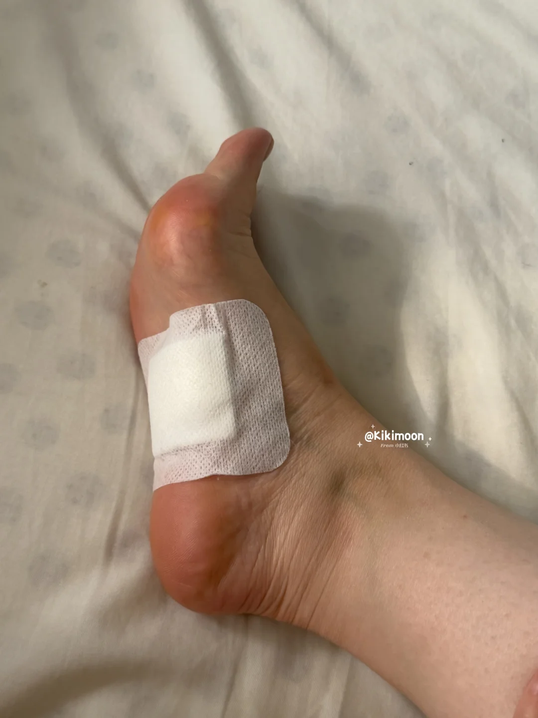 深圳北大医院切痣点痣经验分享（最新）