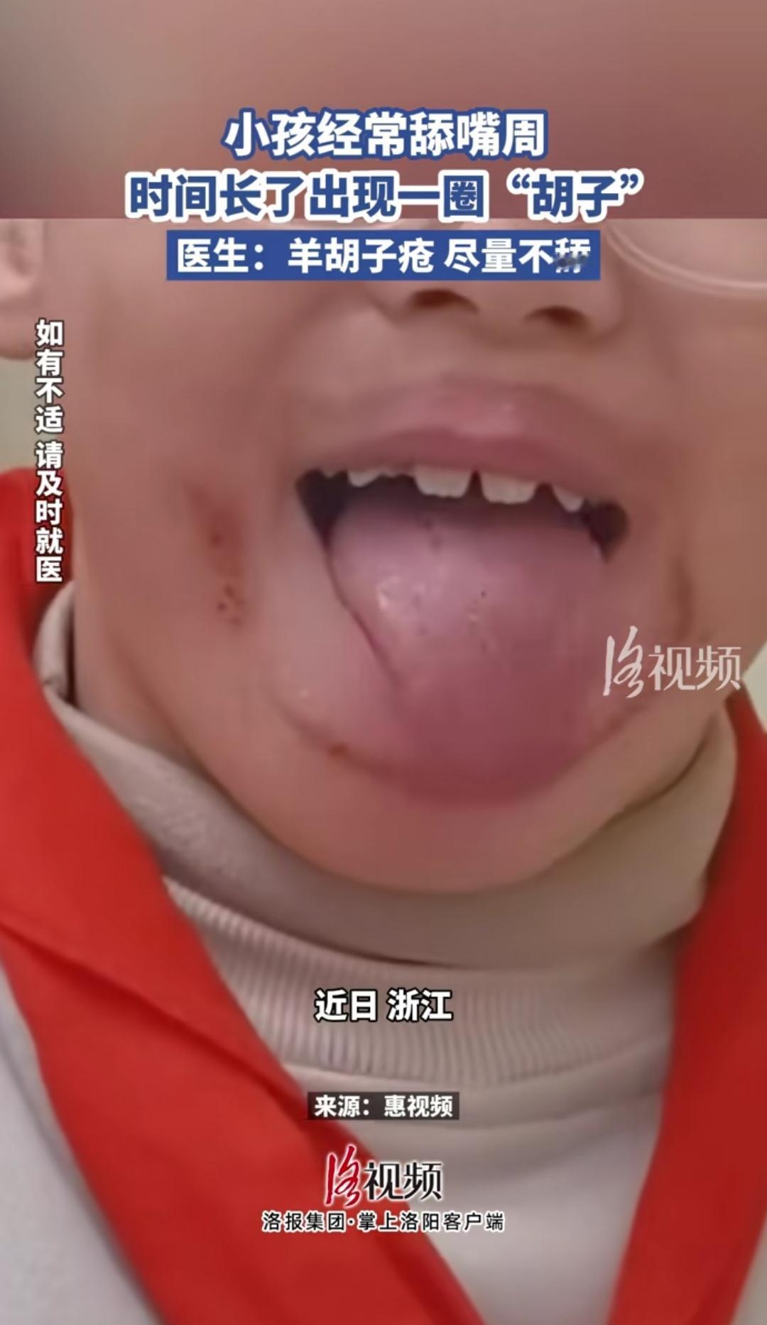 笑不活了[捂脸]

又好笑又无奈，小朋友总是舔嘴唇，导致干裂，弄的像一圈胡子。