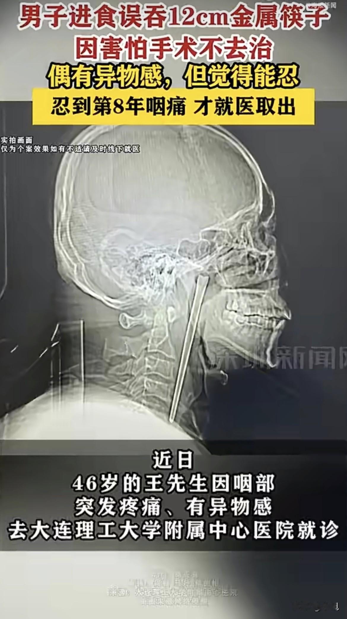 大连一位大哥，喉咙里住着一根12厘米长的金属筷子，整整八年。要不是这次疼得受不了